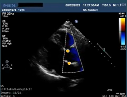 Power of AI Assessment of Echo Measurements